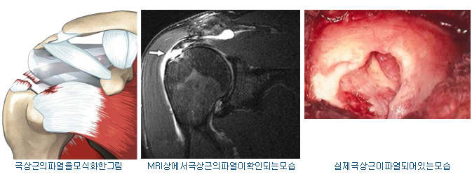 어깨 수술 준비 (회전근개파열, 충돌증후군...ㅜㅜ)  [1]